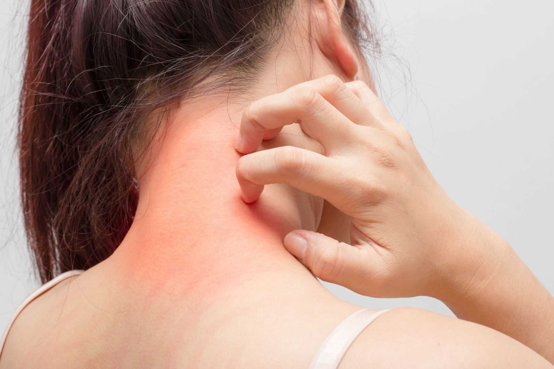 What you need to know about scabies